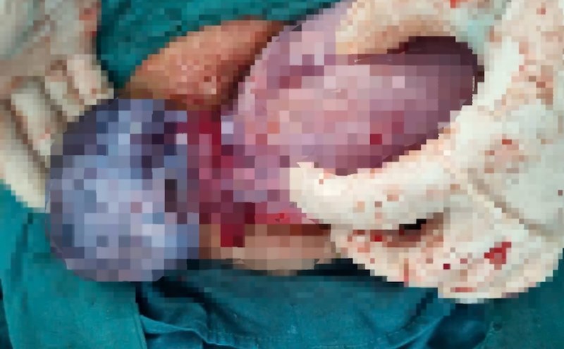 Image of the baby born with a returned cyst that was destroying his mother in Quang Tri. Photo: Quang Ninh Regional General Hospital