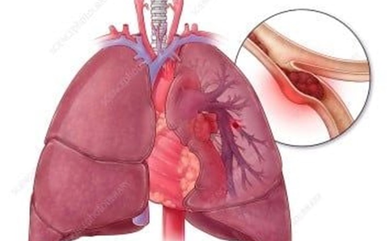 Illustrative image of lung principle. Long-term use of birth control pills is high in risk of disease. Photo: People's Hospital 115