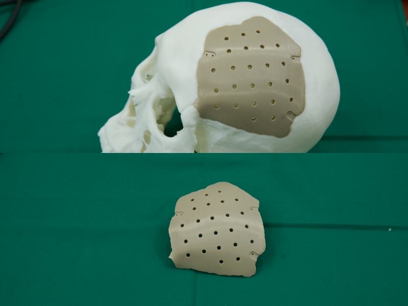 The first personalized 3D printed PEEK skull replacement made in Vietnam. Photo: Duc Van