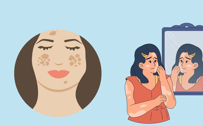 Excessive skin black has a big impact on women's beauty and psychology. Graphic photo: Hoang Loc