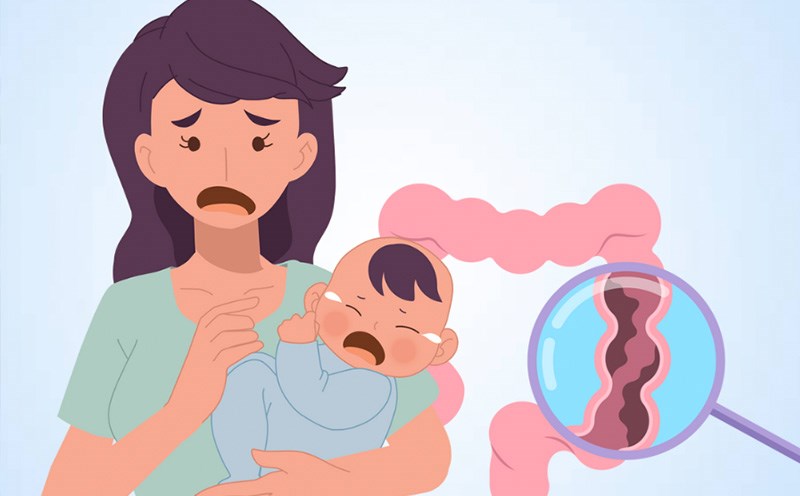 Foods that can cause constipation in infants. Graphics: Thien Nhan