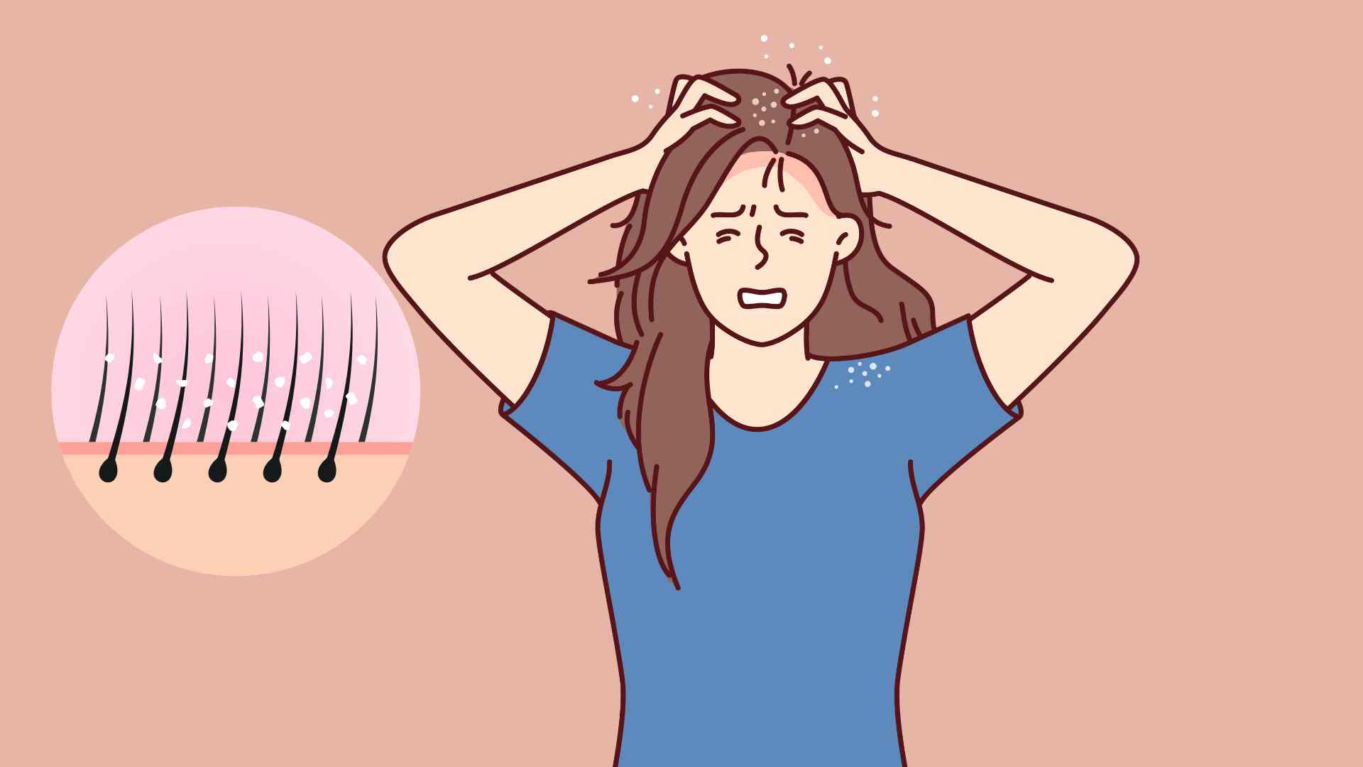 Itchy scalp not only causes discomfort but also affects confidence. Graphic photo: Hoang Loc