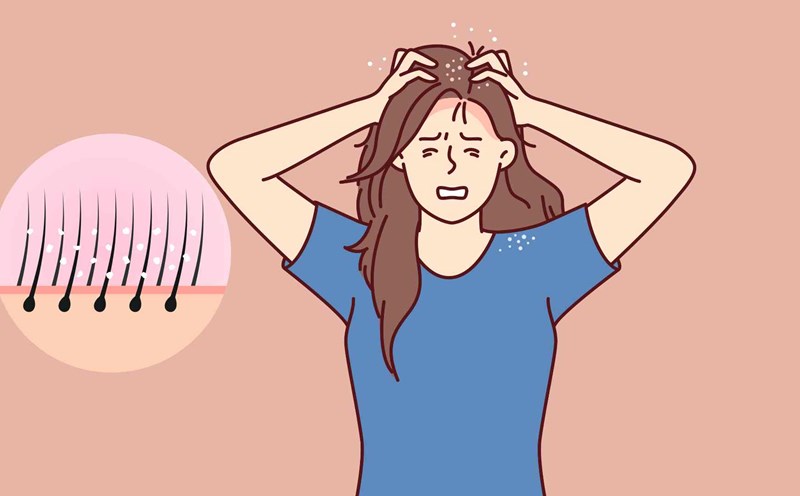 Itchy scalp not only causes discomfort but also affects confidence. Graphic photo: Hoang Loc