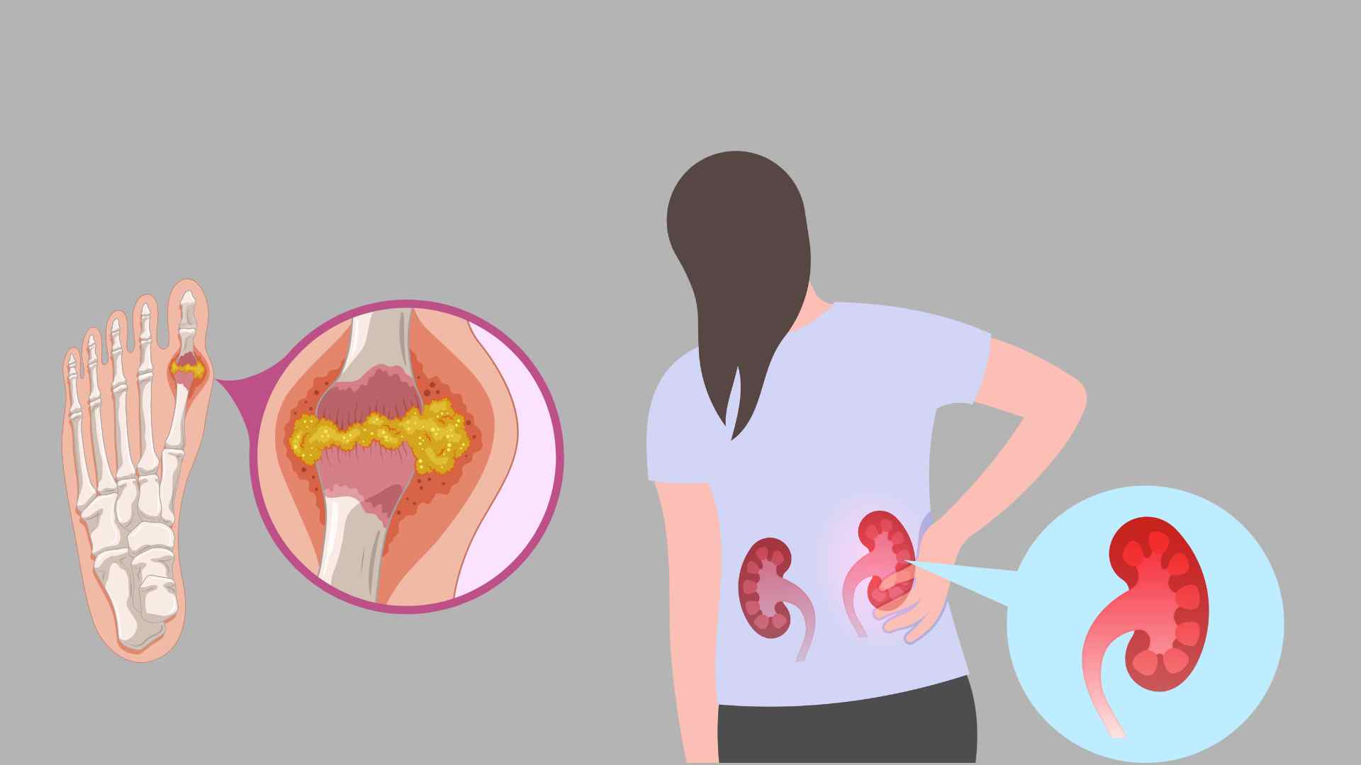 Some warning signs that uric acid is exceeding the safe threshold. Graphic photo: Hoang Loc