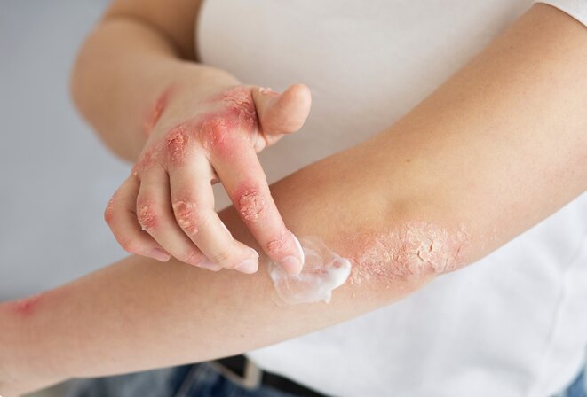 How to prevent allergies during the rainy season. Photo: Thuy Duong