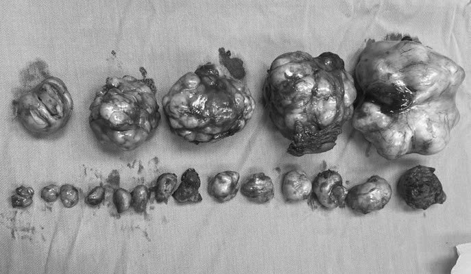 Les 19 fibromes uterins du patient. Photo : BVCC