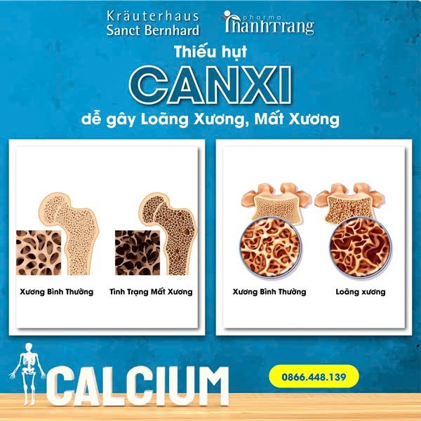 Thieu hut canxi de gay loang xuong, mat xuong Anh: Thanh Trang Pharma