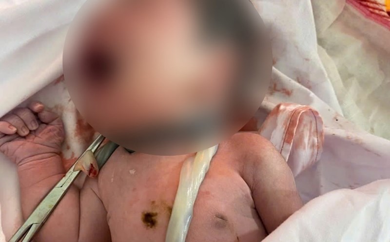 The baby was born with 6 umbilical cord loops around his neck. Photo: Tuyen Hoa Regional General Hospital