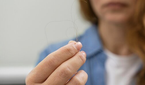 What is self-immunomental hair loss? Photo: Thuy Duong