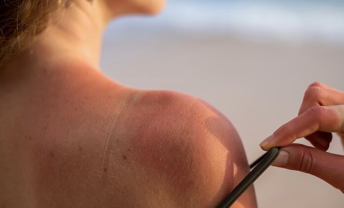 日焼けと日光中毒を区別する。写真:トゥイ・ズオン