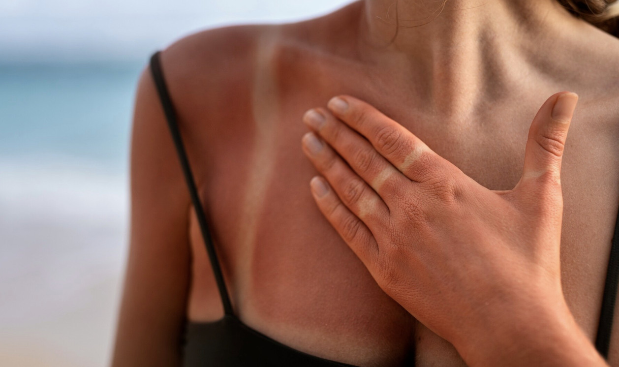 The pain will be cured as long as it is sunburned. Photo: Thuy Duong