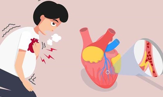 Những dấu hiệu quan trọng giúp bạn phân biệt giữa tình trạng đau tim và ngừng tim. Đồ họa: Thái Anh
