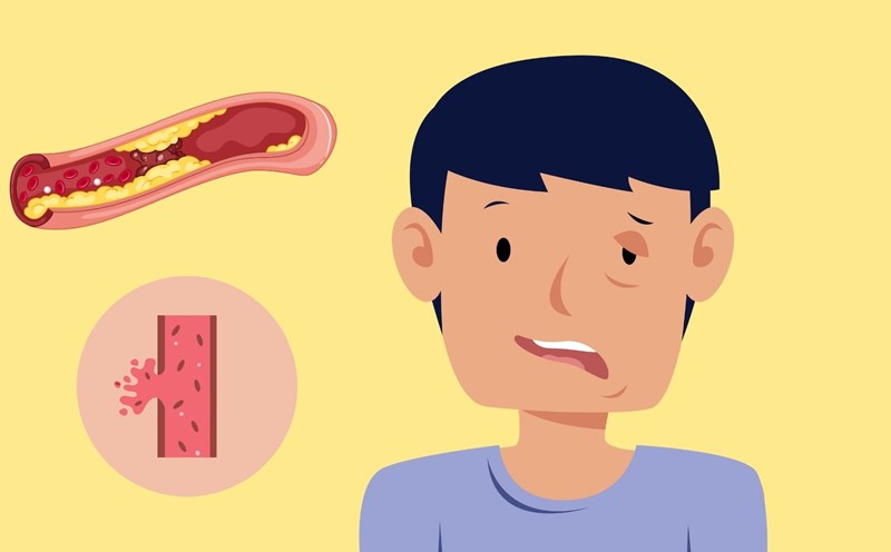 Bệnh viện Bạch Mai khuyến cáo cách phòng tránh đột quỵ khi nắng nóng cực đoan