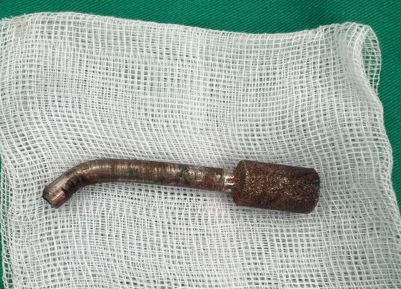 Di vat (la mui khoan) sau khi duoc phau thuat, lay ra ngoai. Anh: Benh vien cung cap