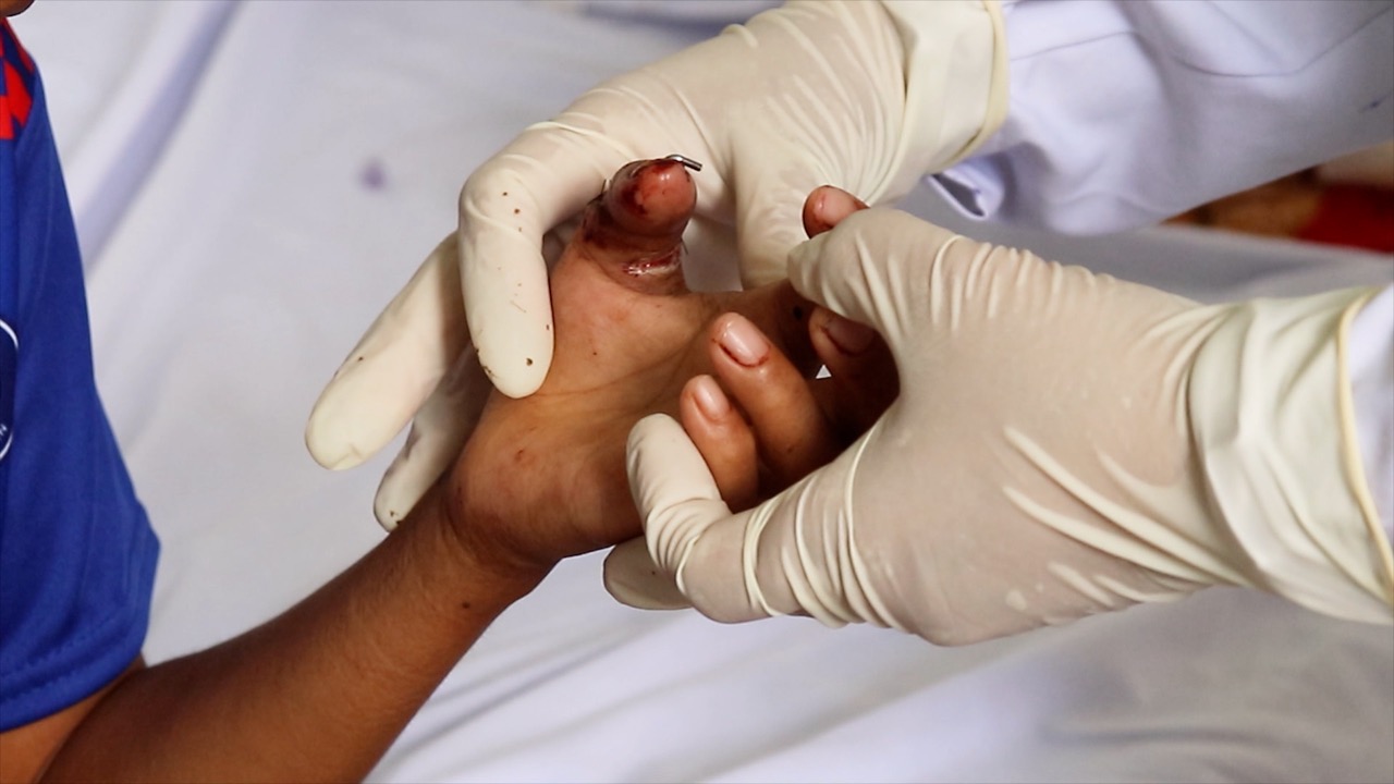 The patient's two fingers were successfully retained by the surgeon. Photo: Children's Hospital 2