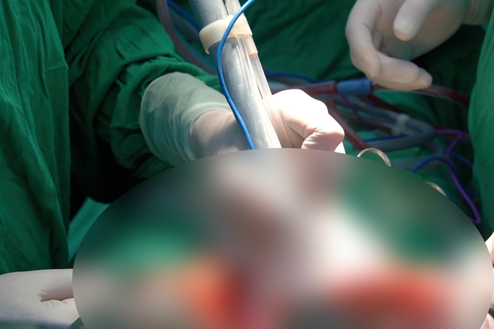 Can Tho patient with liver cancer revives thanks to modern technology