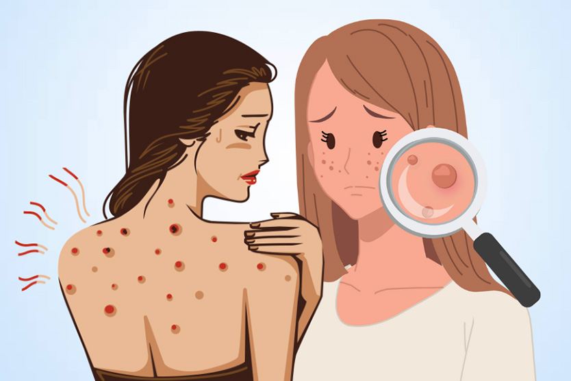 真菌性ニキビと細菌性ニキビの区別方法。イラスト:ティエン・ニャン