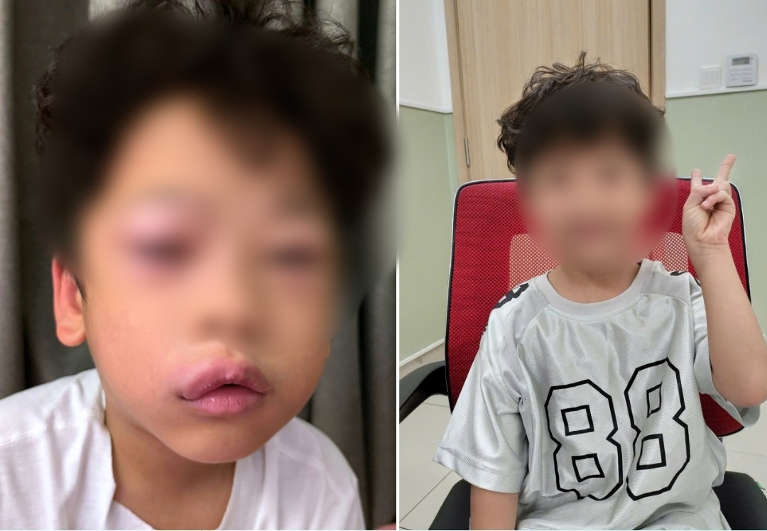 Be trai bi di ung, phu mach sau khi choi slime. Anh: BVCC