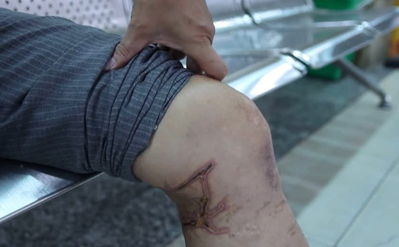 The patient was attacked by seaweed. Photo: Lan Anh