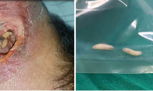 Hình ảnh giòi được gắp ra khỏi ổ hoại tử của bệnh nhân. Ảnh: BVCC