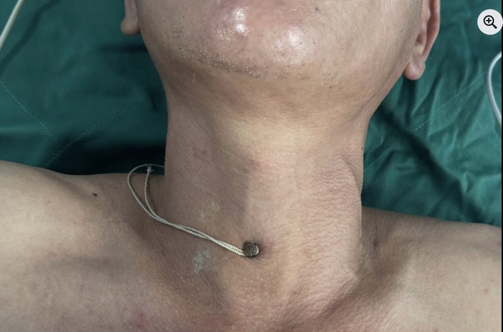 The man with a steel nail stuck deep into his neck while constructing the project was hospitalized for emergency care. Photo: BVCC