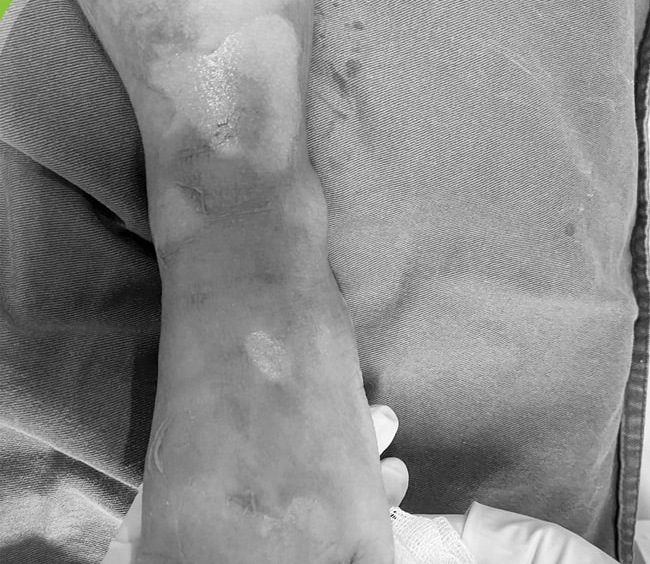 Image of the burns of one of the three children at the time of hospitalization. Photo: BVCC