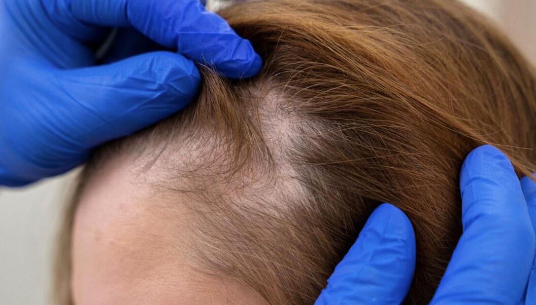 Con lăn da đầu, bí quyết kích thích mọc tóc an toàn và hiệu quả