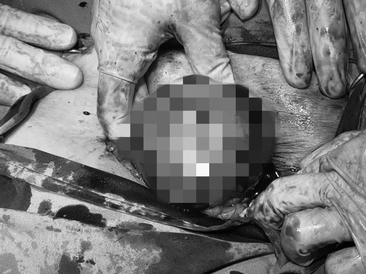 The patient had a "huge" ovarian cyst. Photo: Quang Ninh Regional General Hospital