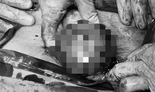 Bệnh nhân có khối u nang buồng trứng "khủng". Ảnh: Bệnh viện Đa khoa khu vực Quảng Ninh