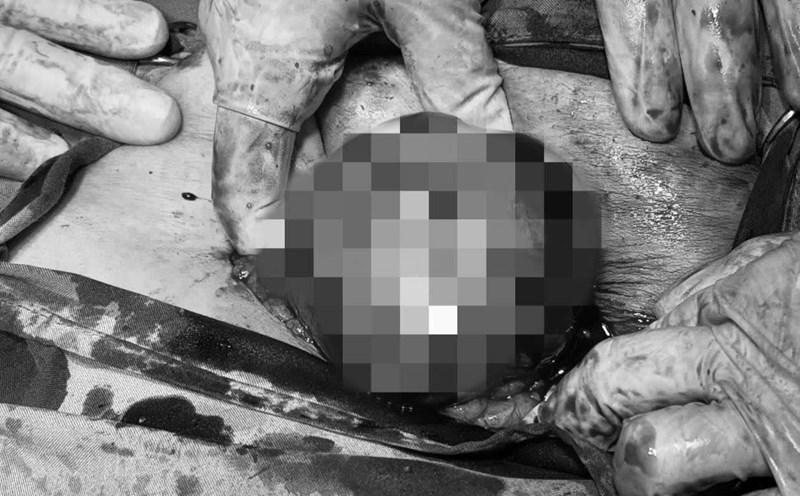 The patient had a "huge" ovarian cyst. Photo: Quang Ninh Regional General Hospital