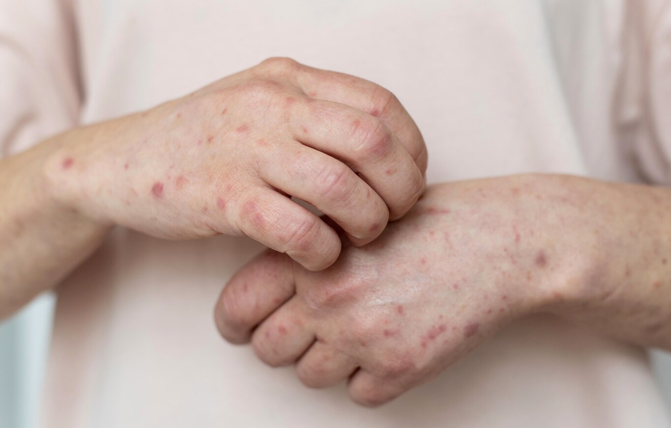 The main route of mpox disease. Photo: Thuy Duong