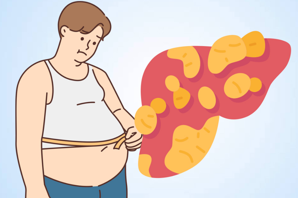 Tăng cân đột ngột có thể là dấu hiệu của bệnh gan nhiễm mỡ. Đồ họa: Thiện Nhân