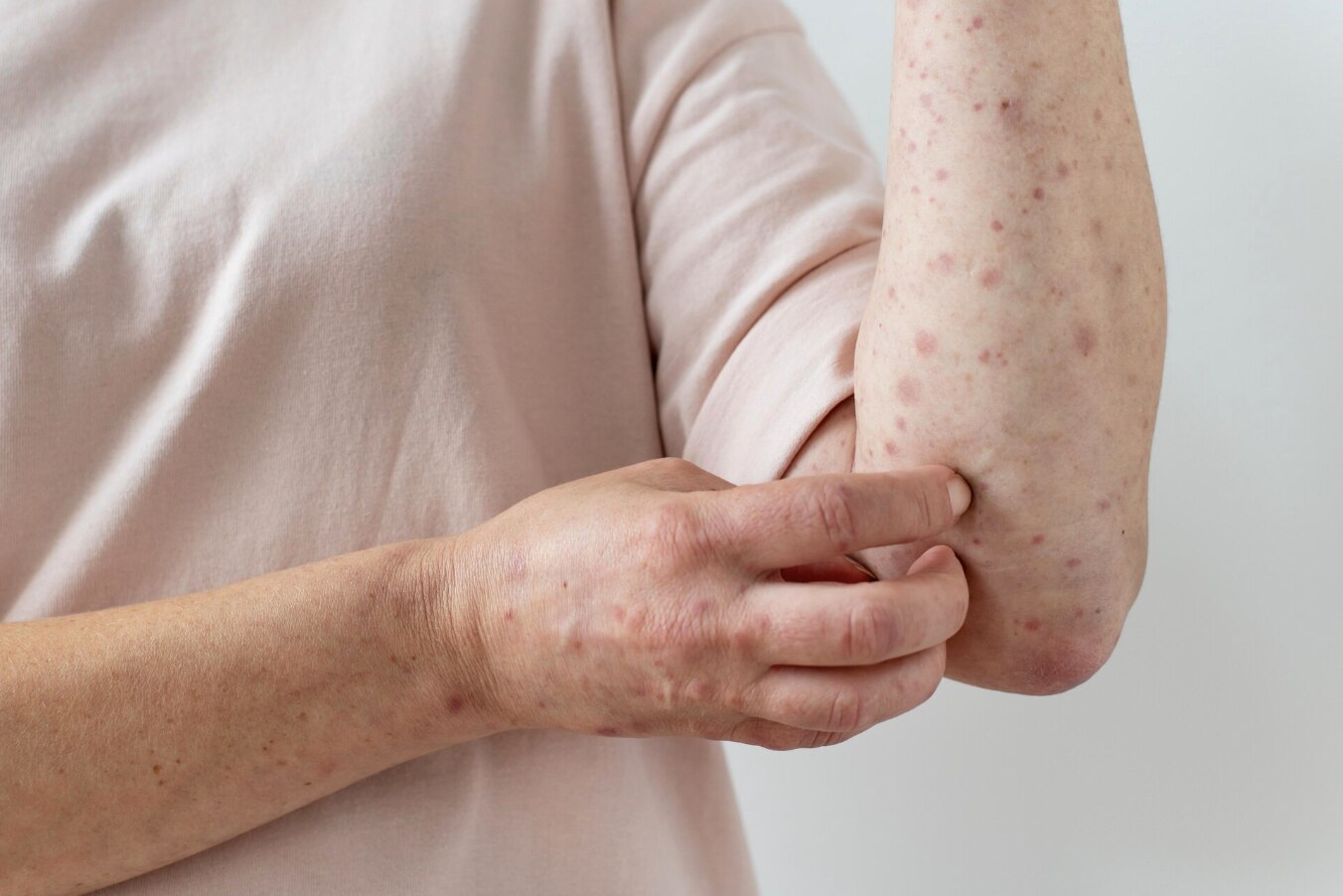 psoriatic arthritis, a silent danger. Photo: Thuy Duong