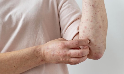 Viêm khớp vảy nến, mối nguy âm thầm. Ảnh: Thùy Dương