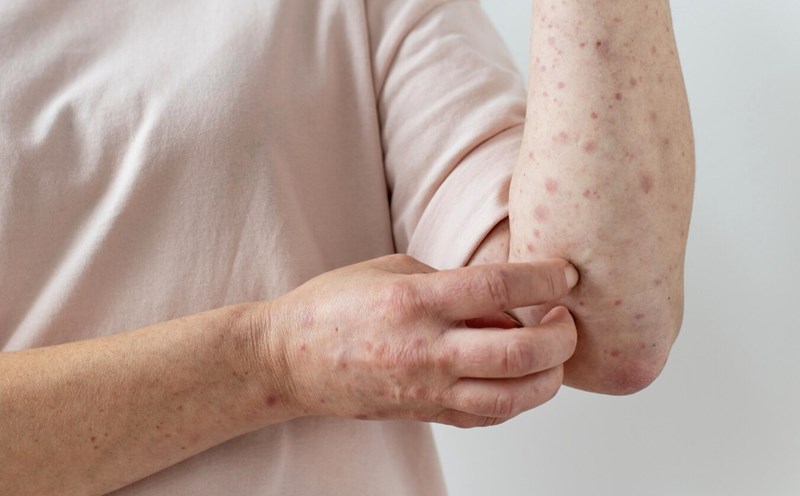psoriatic arthritis, a silent danger. Photo: Thuy Duong