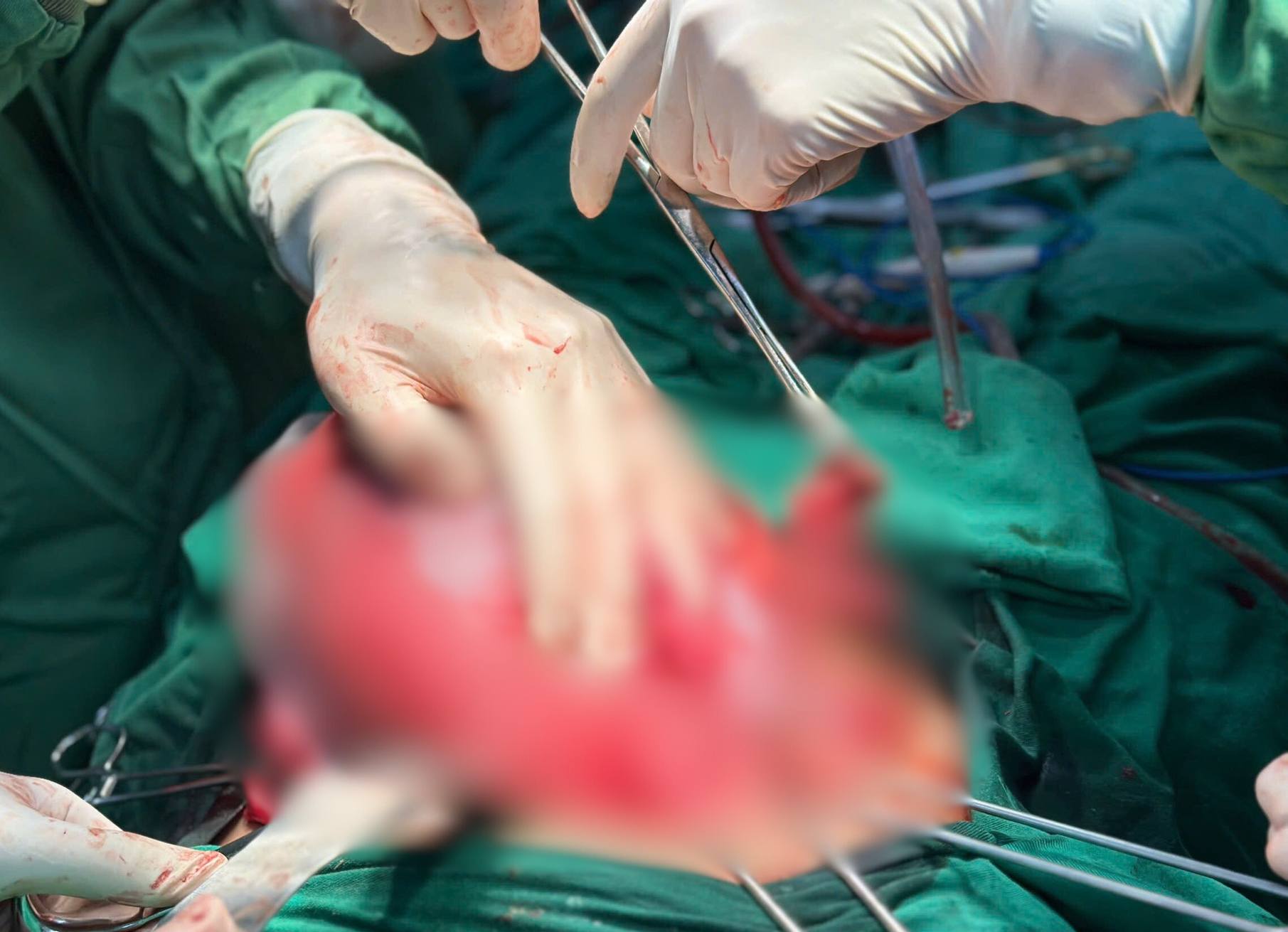 34주 산모 맹장 파열 응급 치료 성공. 사진: BVCC