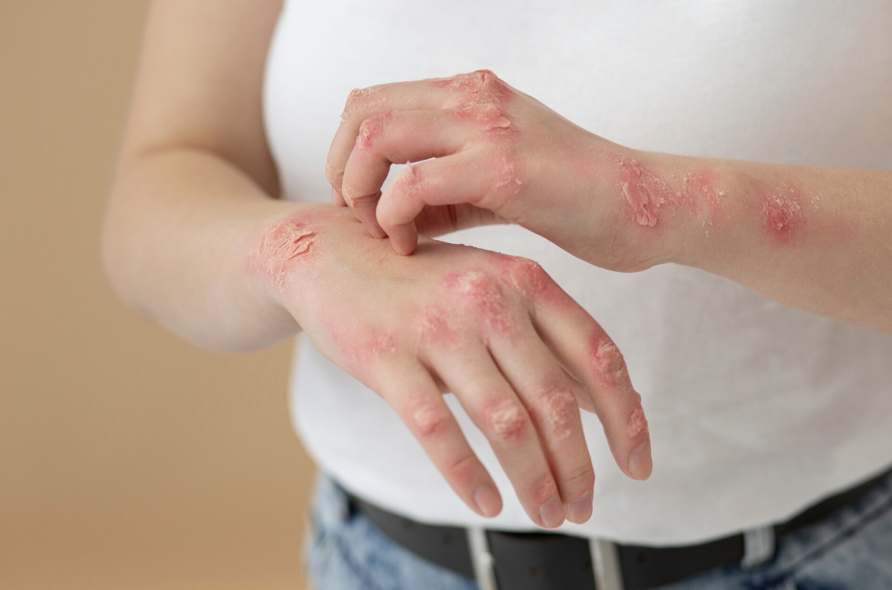 Symptoms and causes of lupus arthritis. Photo: Thuy Duong