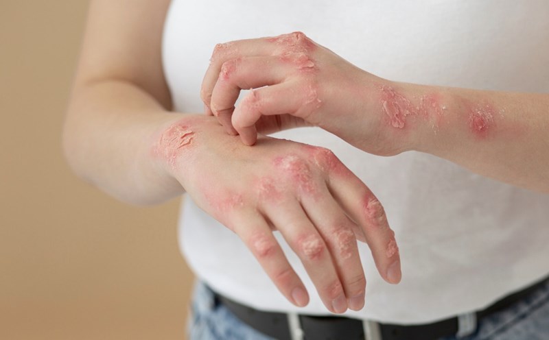 Symptoms and causes of lupus arthritis. Photo: Thuy Duong