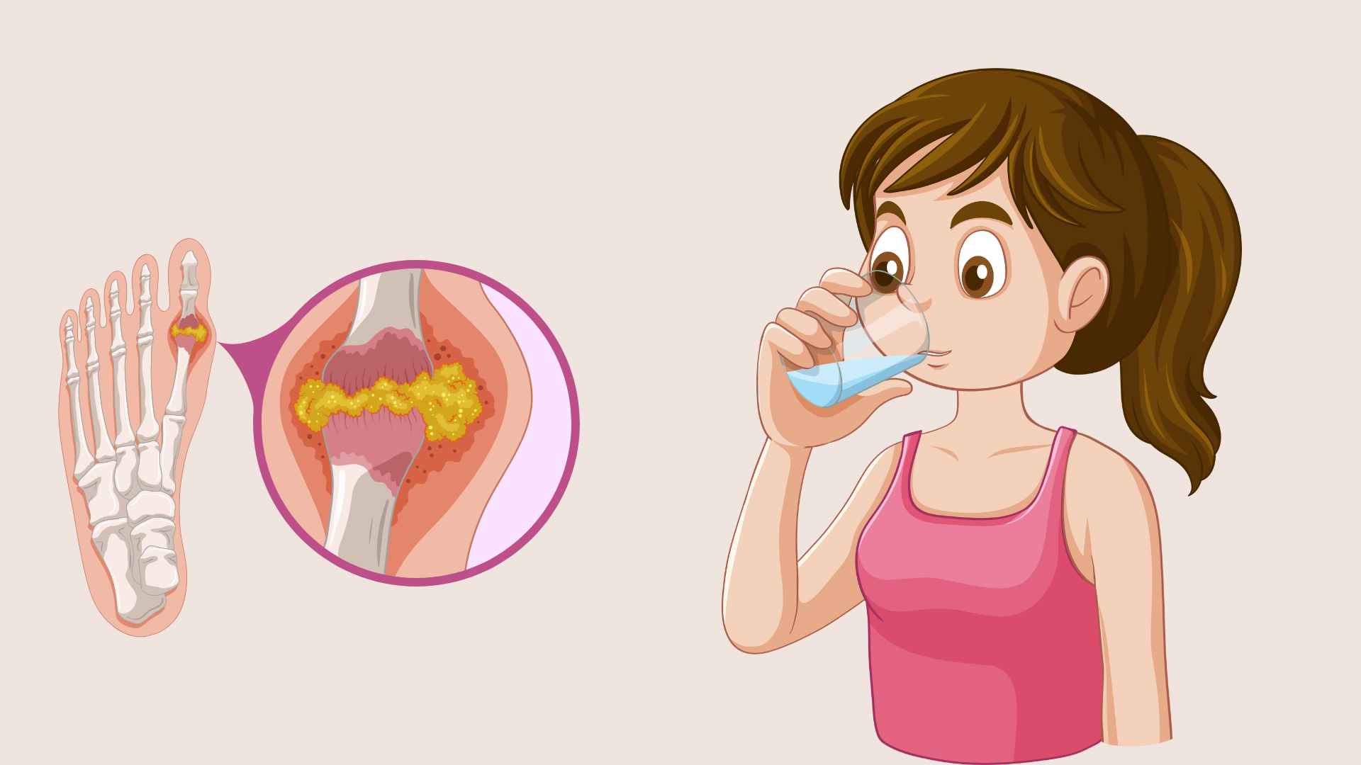 The habit of drinking warm water before bed helps prevent uric acid spikes. Graphic photo: Hoang Loc
