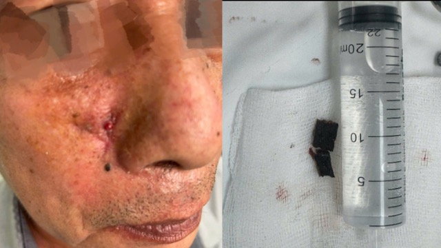 The foreign object in the nasal wing was removed from the patient. Photo: BVCC