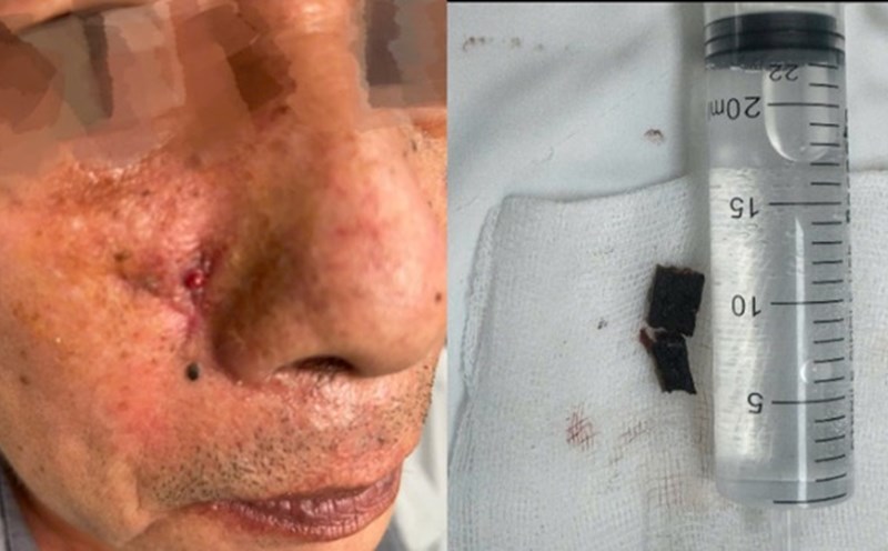 The foreign object in the nasal wing was removed from the patient. Photo: BVCC