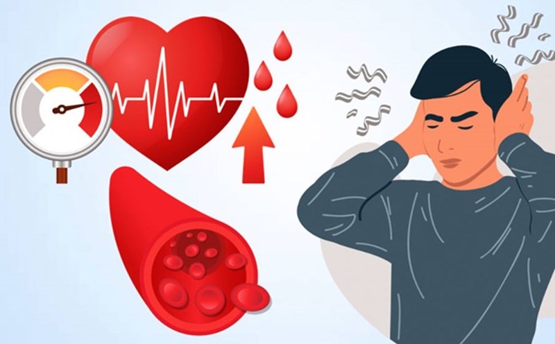 Stress can cause temporary high blood pressure, but if it is prolonged with an unhealthy lifestyle, the risk of progressing to chronic high blood pressure is very high. Graphics: Thien Nhan