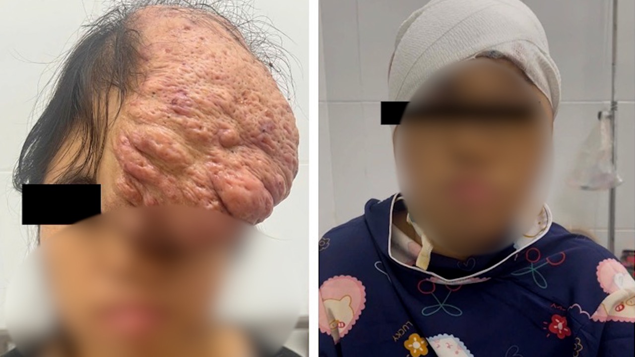 The patient underwent successful surgery for a giant tumor. Photo: Provided by the unit