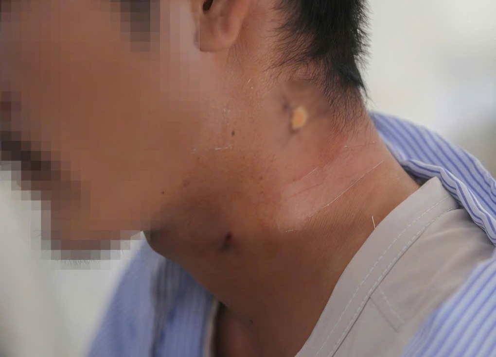 Vi tri vet thuong do manh sat gay tu luoi may cat co, vang vao co nan nhan. Anh: An Phuoc