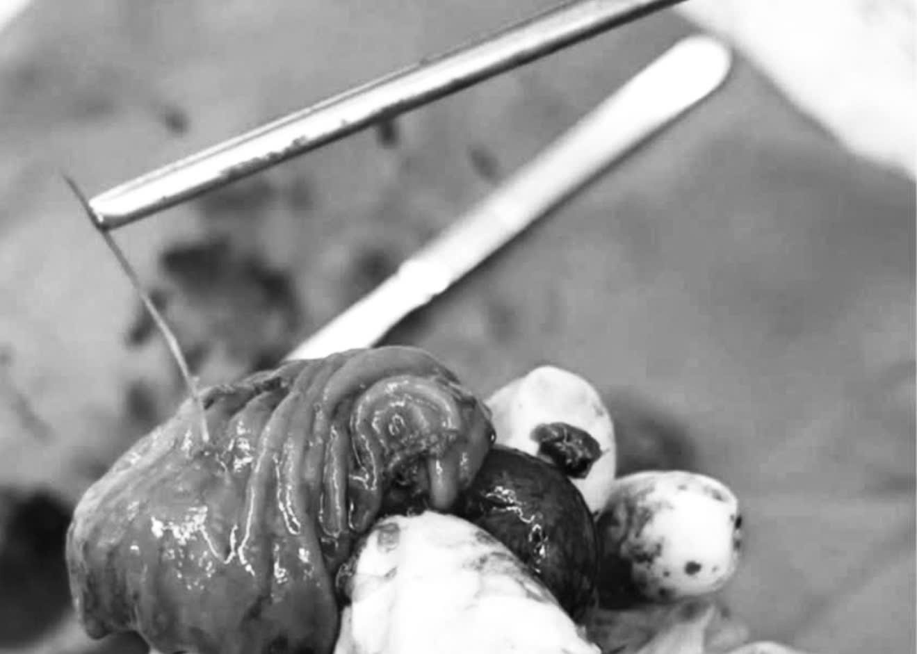 4cm 생선 가시는 환자의 소장을 뚫어 복강 농양을 유발합니다. 사진: Thanh Dang