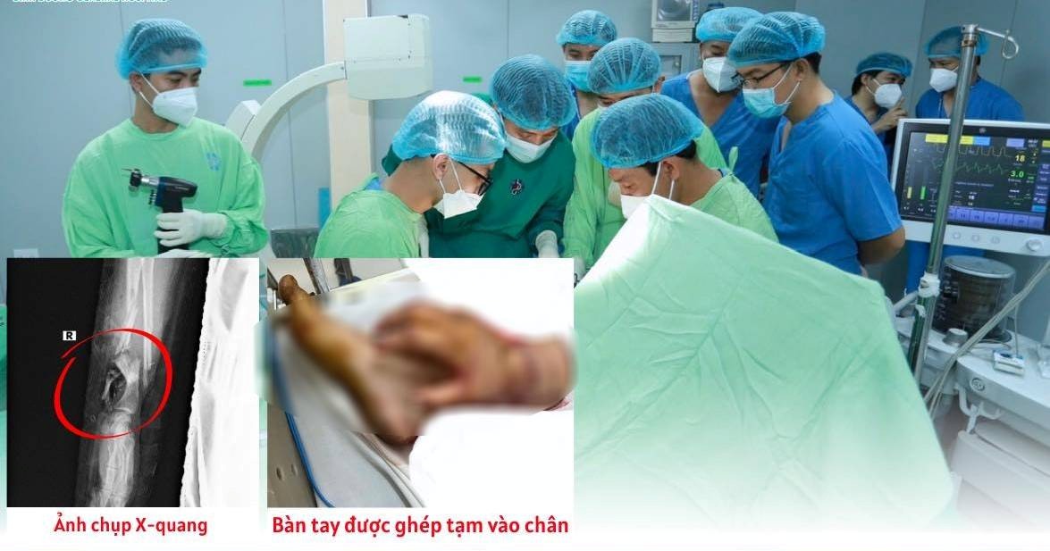 Temporary graft of a severed hand into a woman's leg waiting for her to recover her function. Photo: Binh Duong General Hospital