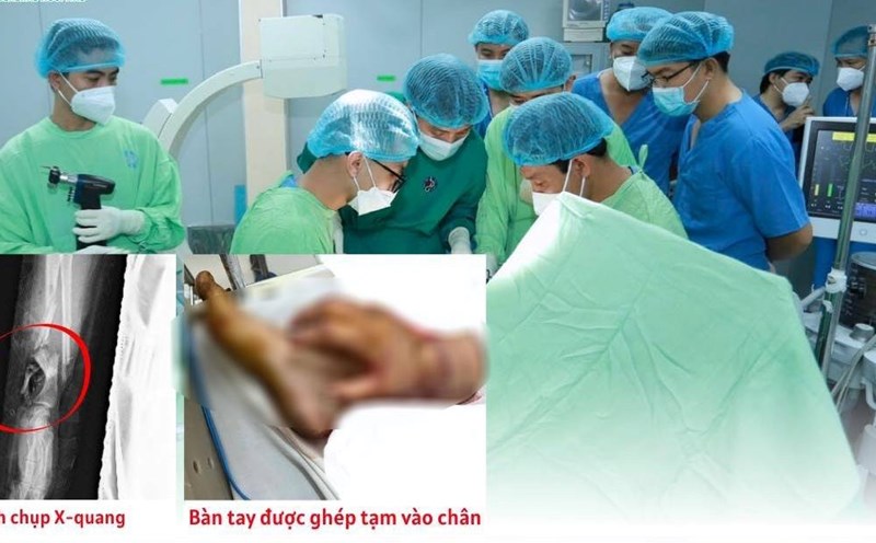 Temporary graft of a severed hand into a woman's leg waiting for her to recover her function. Photo: Binh Duong General Hospital