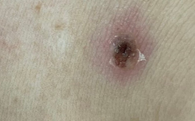 Typical ulcers of enteritis in the armpits. Photo: BVCC