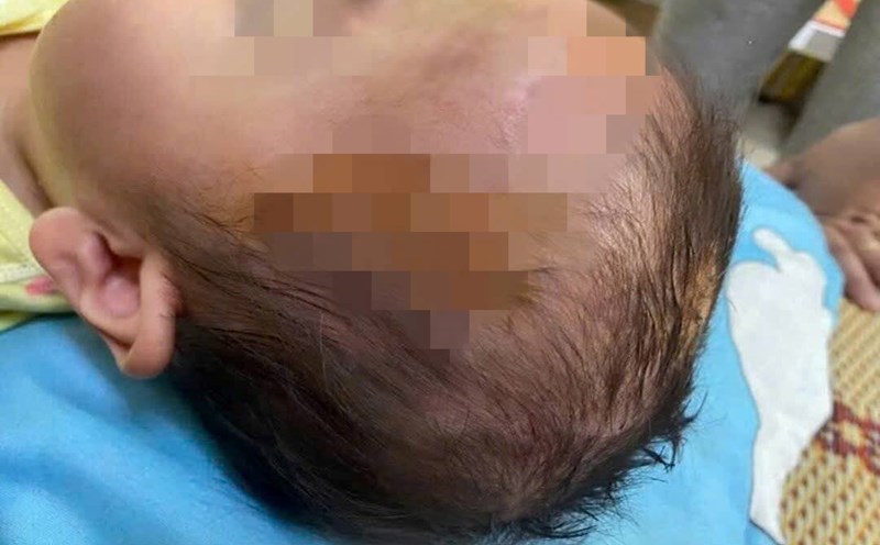 The child was bitten by a dog in many areas of the head and face. Photo: CDC Hue.