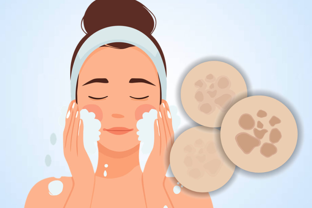 Mistakes in skin care make melasma worse. Graphics: Thien Nhan